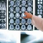 A doctor points at an MRI scan (Photo: Anna Shvets)