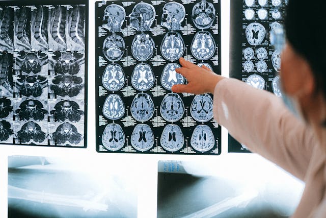 A doctor points at an MRI scan (Photo: Anna Shvets)